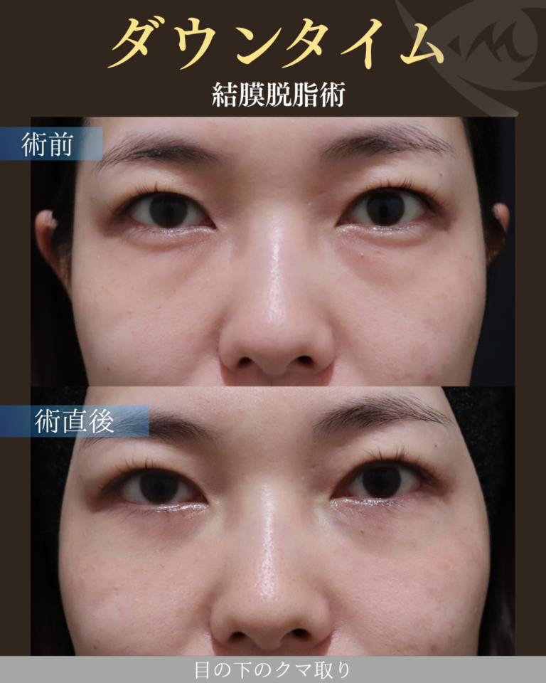 30代女性 経結膜脱脂術 ダウンタイム